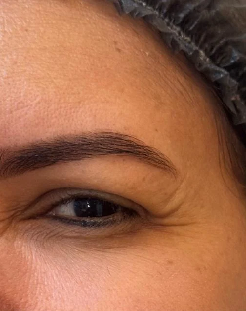 Antes: linhas no canto dos olhos