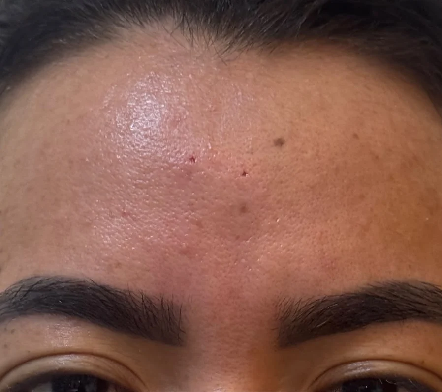 Depois: região glabelar após o tratamento com fio filler