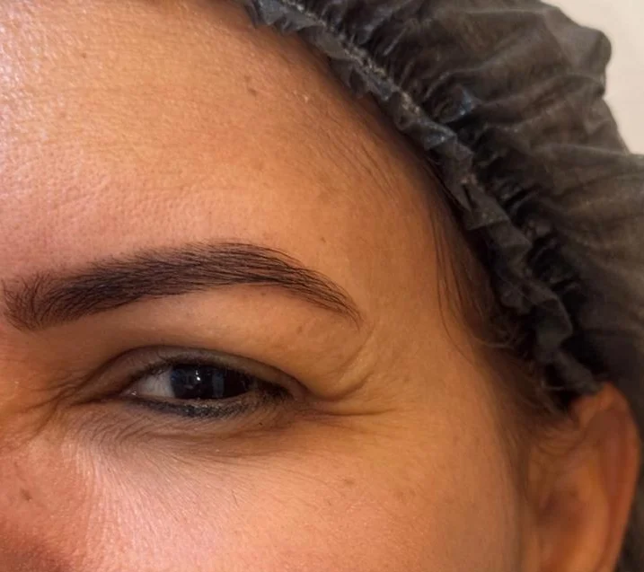 Antes: linhas no canto dos olhos