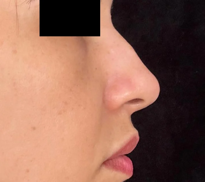 Antes: perfil do nariz, com tarja nos olhos