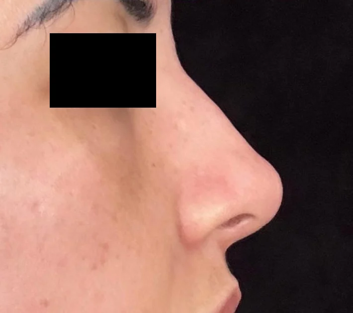 Depois: perfil do nariz após a rinomodelação, com tarja nos olhos