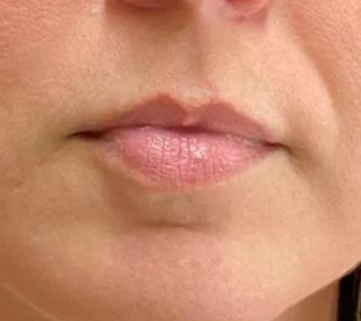 Antes: lábios antes do preenchimento labial