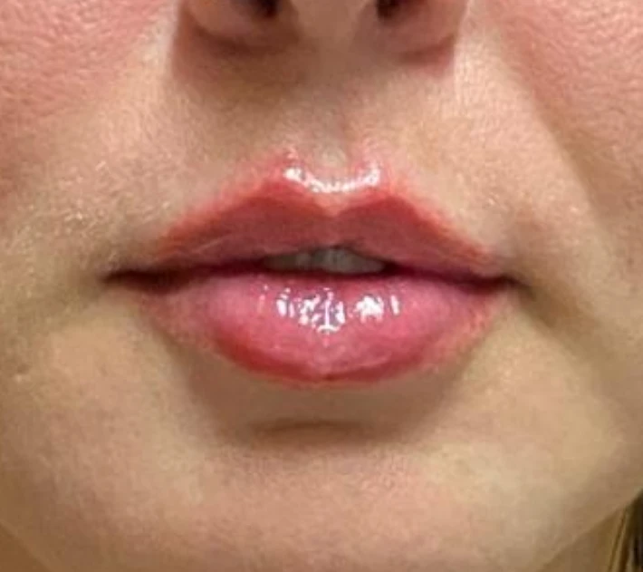 Depois: lábios após o preenchimento labial